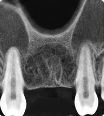 Periapical radiograph of an edentulous site showing the alveolar bone and the roots of the adjacent teeth