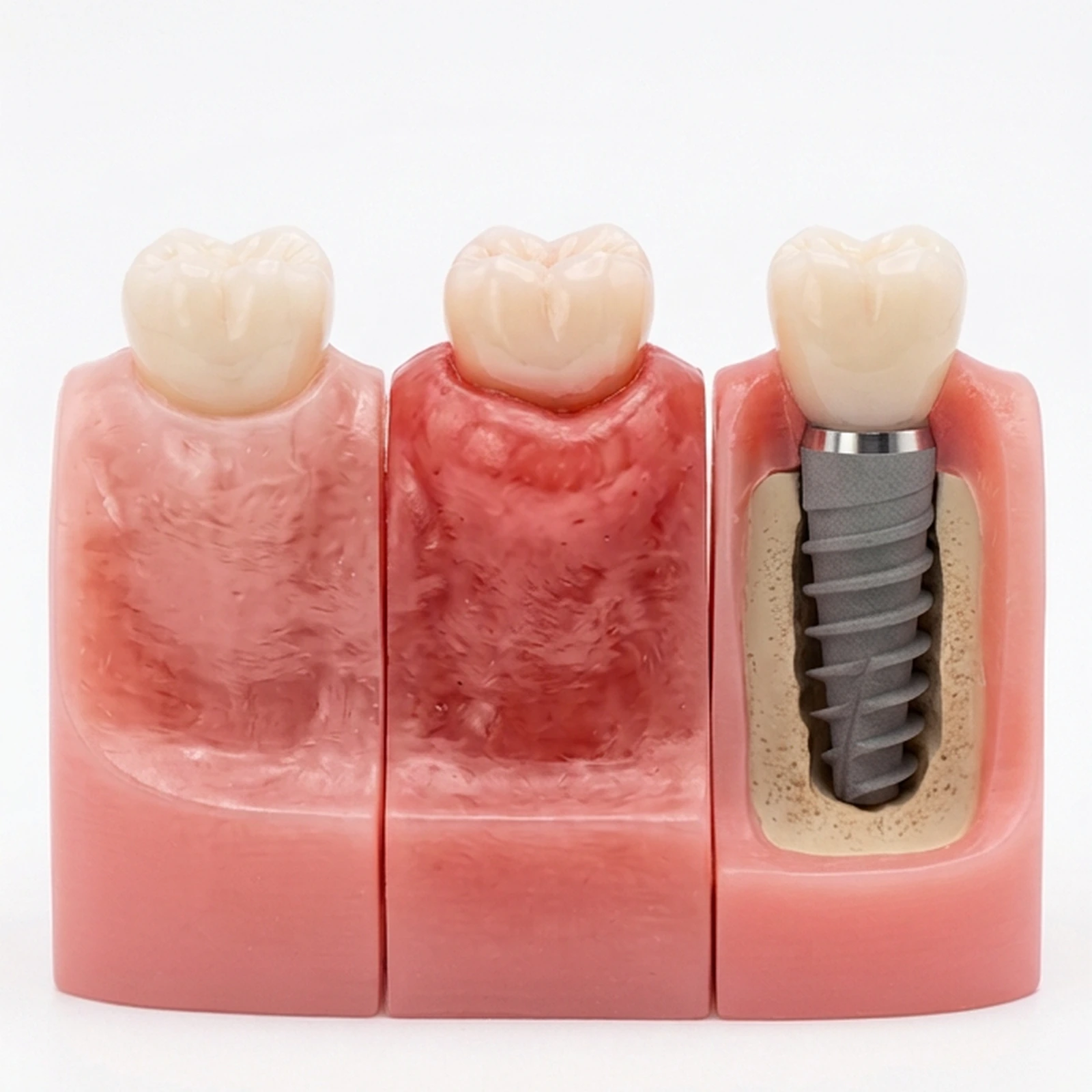 Three-panel illustration comparing healthy peri-implant tissue with stable bone, peri-implant mucositis with inflamed soft tissue and no progressive bone loss, and peri-implantitis with inflammation and progressive bone loss