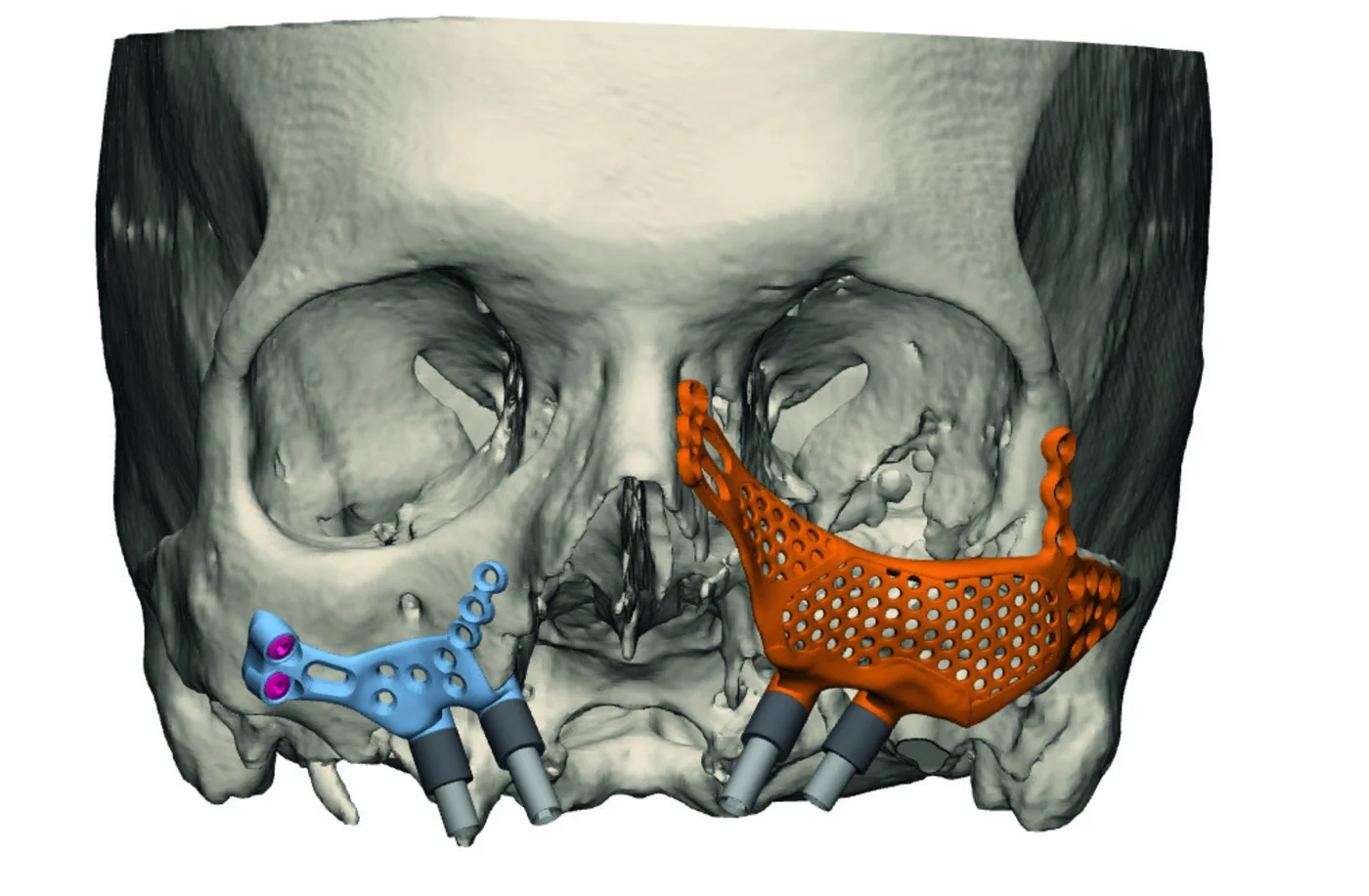Bilateral zygomatic-region PSI frames, planned directly against the patient's own CBCT anatomy.